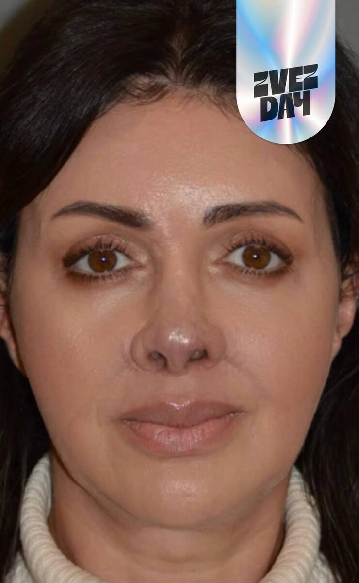 Лицо Алисы Аршавиной после манипуляций врача