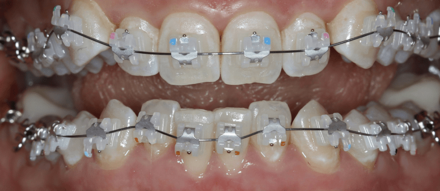Установка ретейнеров после снятия брекетов в стоматологии Пробел