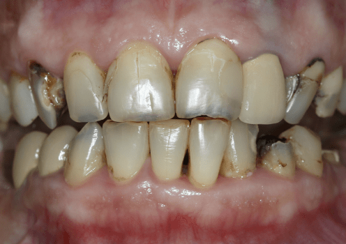 До лечения и установки виниров