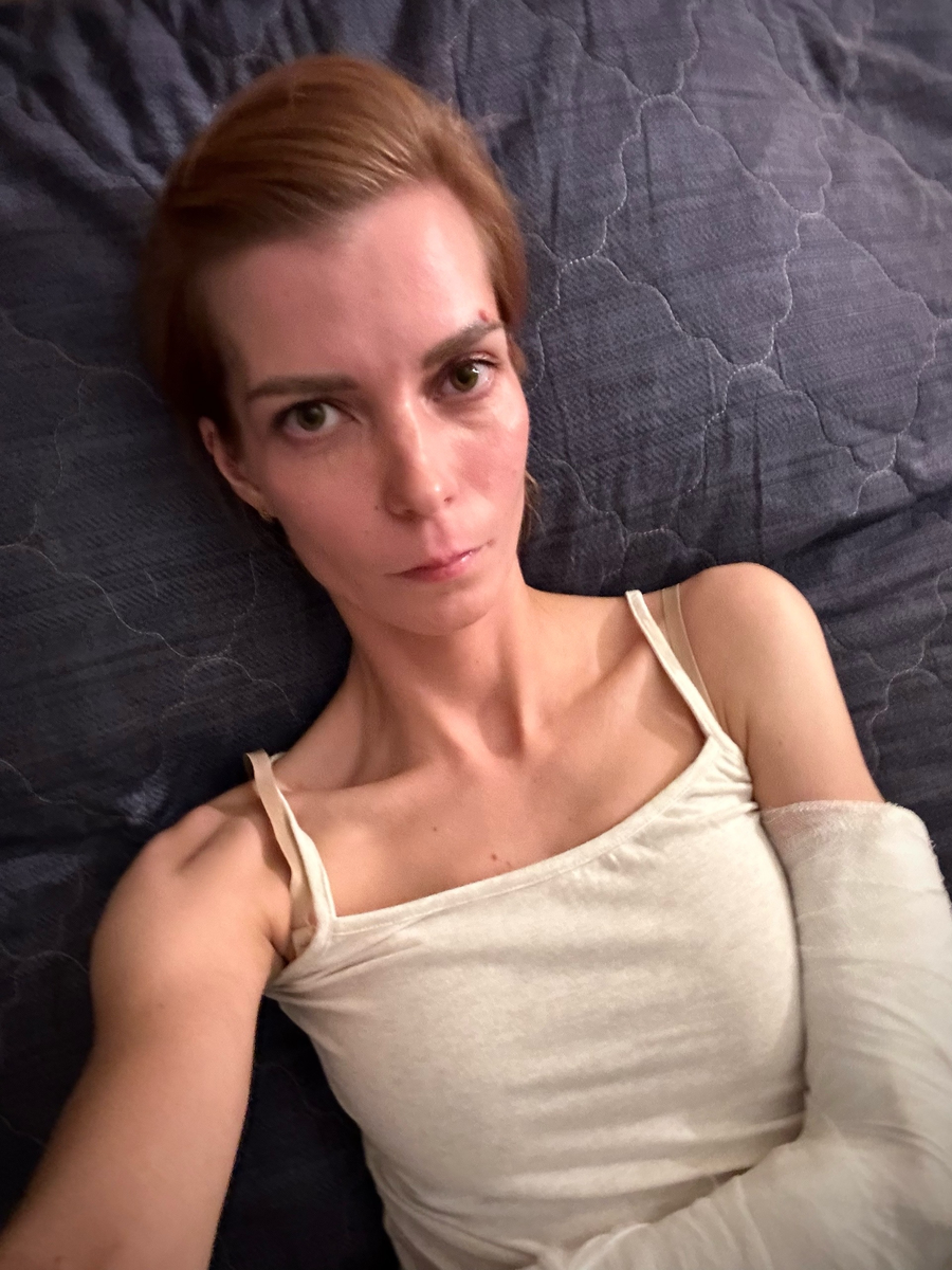 Фото автора. 28 сентября 2023г. Легла отдыхать после 7 часов проведенных в травмпункте. Это я так «удачно» упала с велосипеда на абсолютно прямой дороге. 😁