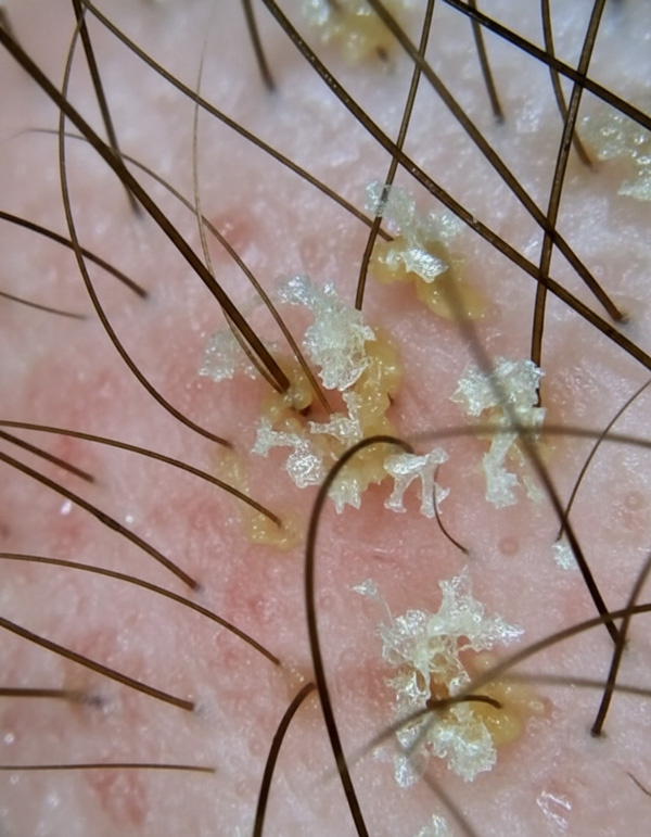 осмотр кожи головы под увеличением ×100