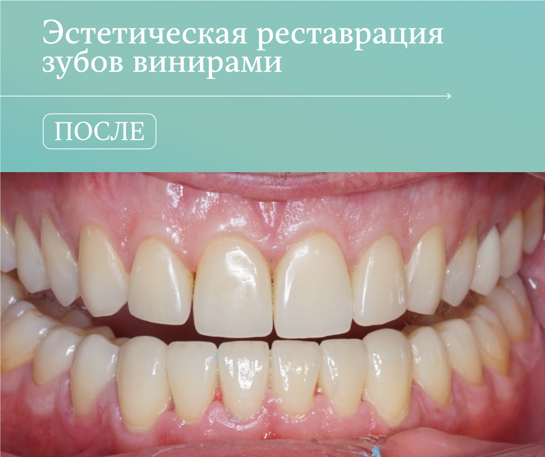 Эстетическая реставрация зубов винирами. Фотография после.