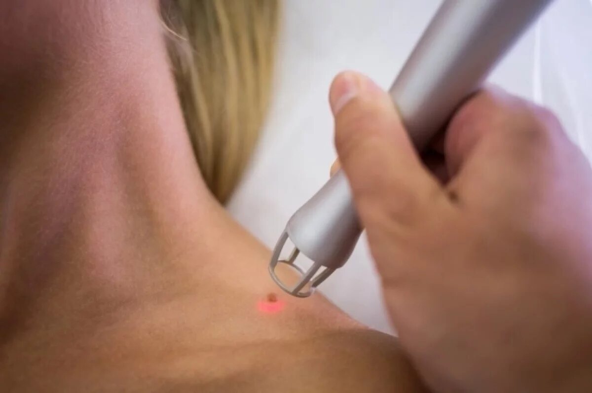    Онколог рассказал, когда жителям Крыма следует насторожиться из-за родинок