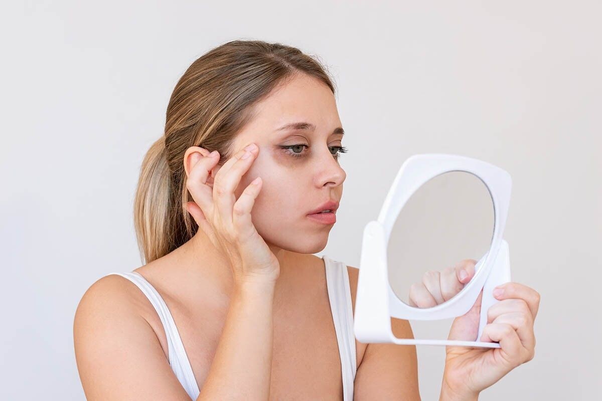 Темные круги под глазами могут указывать на проблемы со здоровьем. Источник: Marina Demeshko / Shutterstock / FOTODOM📷
