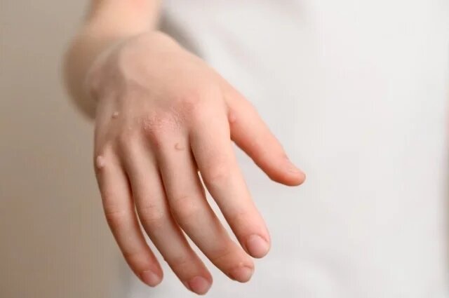    К чему снится бородавка?