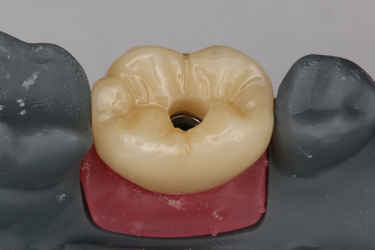 В данном варианте была реализовано коронка на винтовой фиксации.