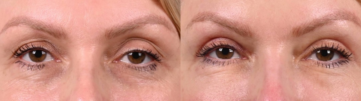 Липофилинг и пластика верхних век с симметризацией. Липофилинг и трансконъюктивальная блефаропластика нижних век. Фото до и после. Фото с сайта хирурга Д.Р. Гришкяна. Имеются противопоказания, требуется консультация специалиста