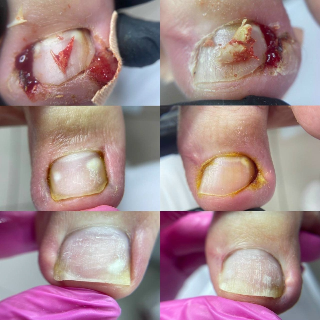 Создать карусельДинамика ведения клиента с гипергидрозом в течении 5 месяцев