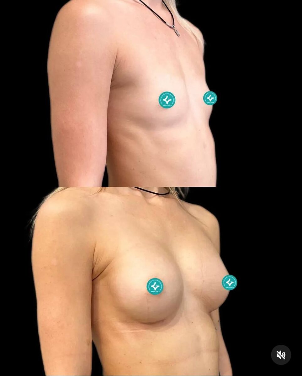 Результаты увеличения груди пластического хирурга Атаманова Дмитрия Константиновича