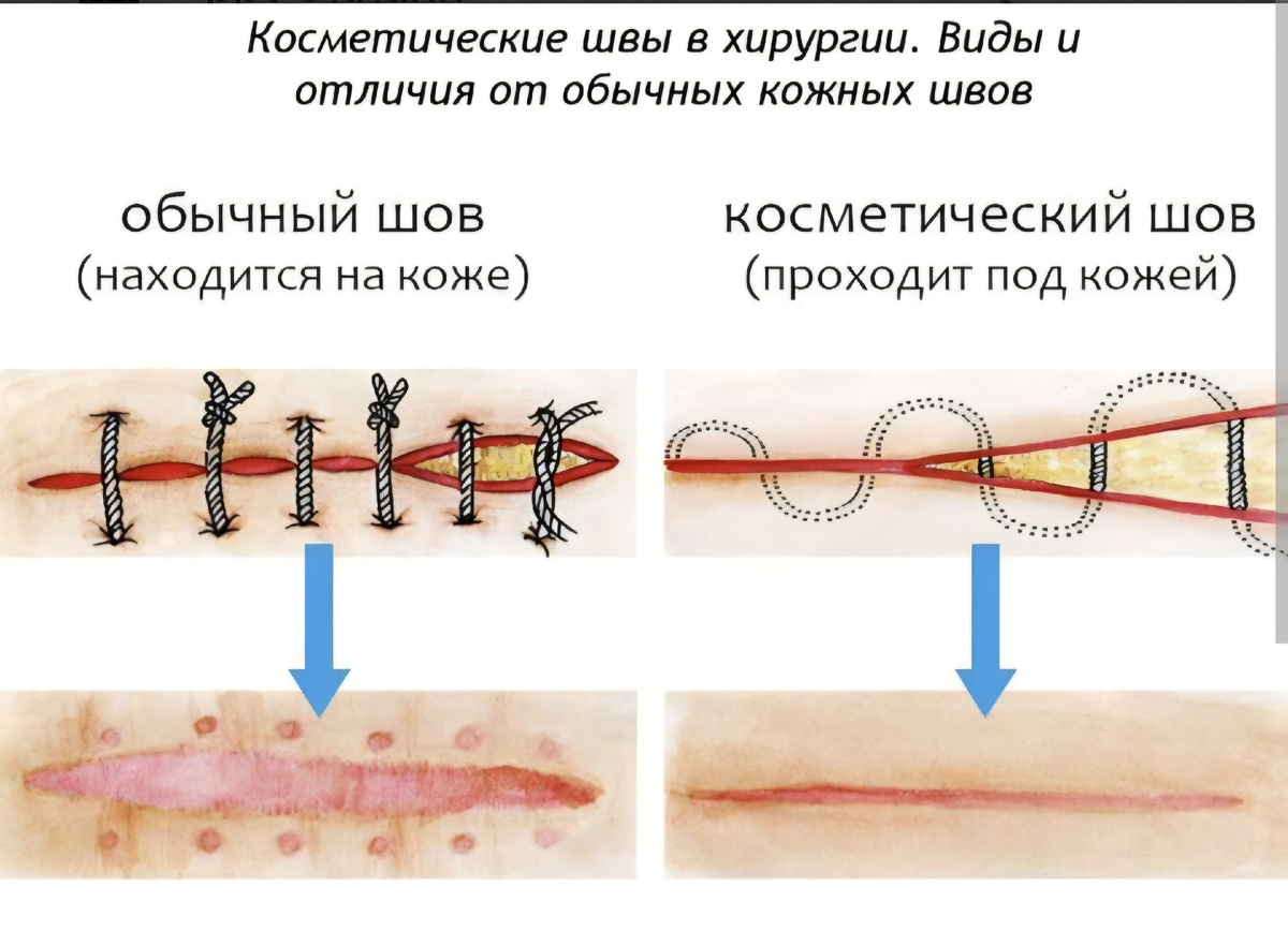 Гладко было на бумаге, да забыли про овраги! Мой тип - справа. Шов разошёлся в одном месте.