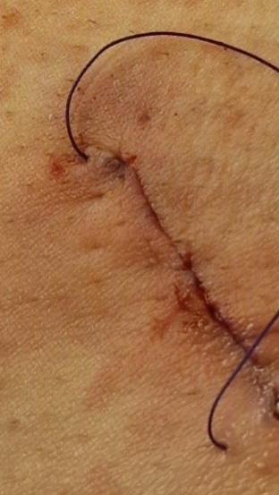 Мой шов до того, как хирург "дёрнул затнитку".