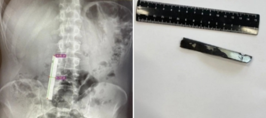   В Югре врачи спасли пациента, проглотившего металлическую пластину