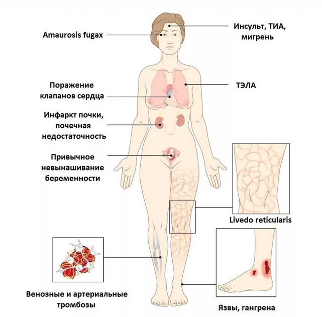 Рис. 1. Антифосфолипидный синдром.