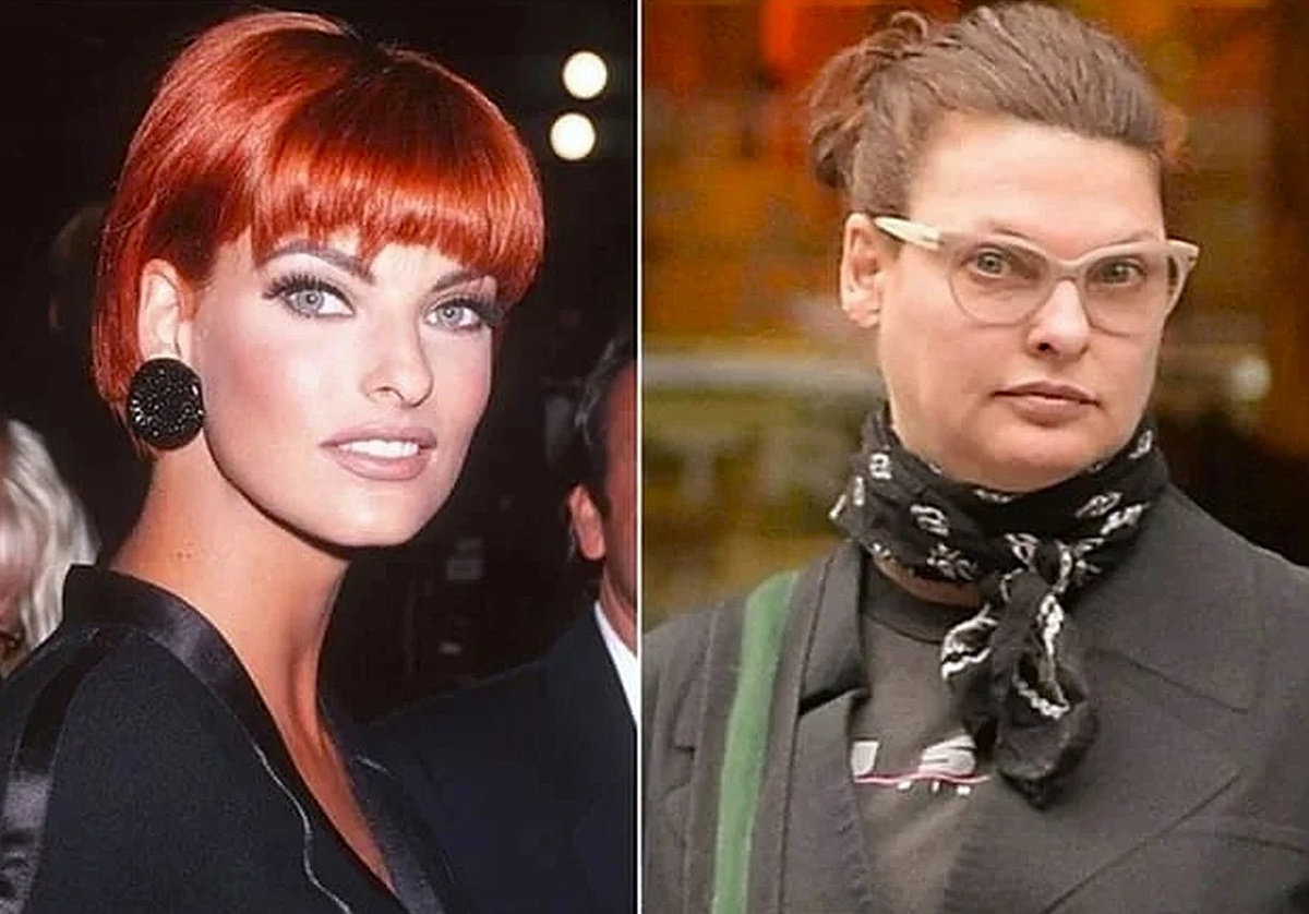 до и после процедуры криополиза. Фото из интернет