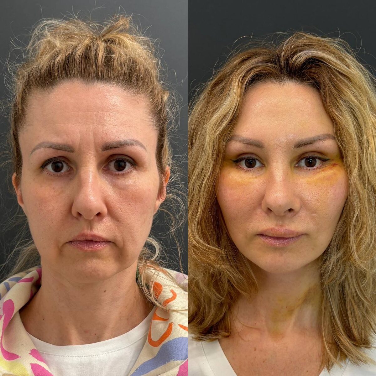 Комплексное хирургическое омоложение лица: 10 дней после операции. Хирург к.м.н. Остринская Т.В.