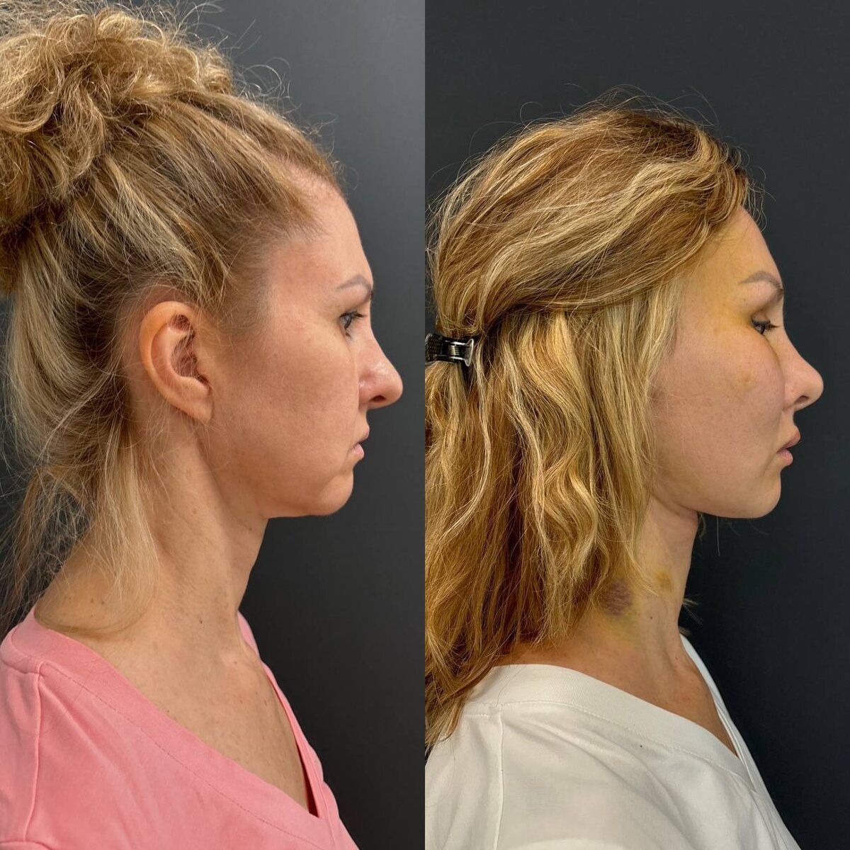 Комплексное хирургическое омоложение лица: 10 дней после операции. Хирург к.м.н. Остринская Т.В.