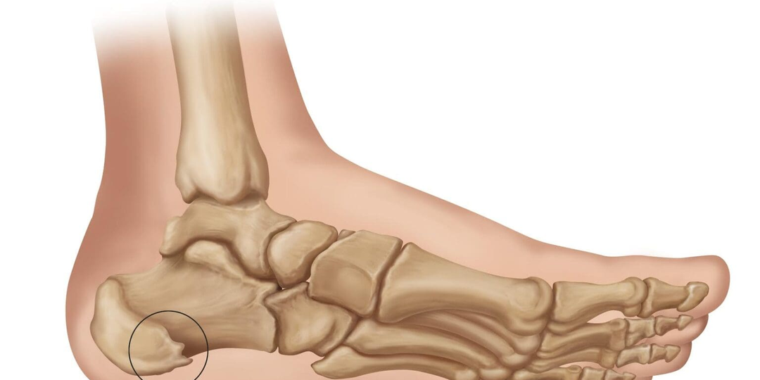 Пяточные шпоры: что делать, чтобы облегчить боль и проблемы с ходьбой