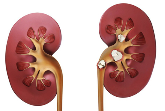 Камни в почках: как распознать, избежать и вывести без паники