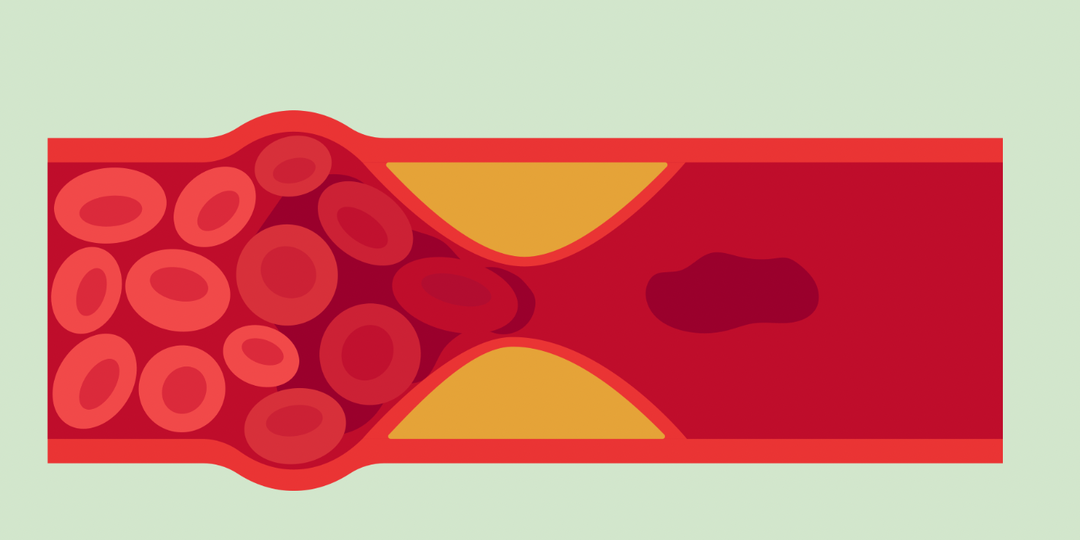 Эти обследования помогут выявить тромбоз и спасти жизнь
