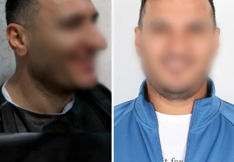 Сколько стоит пересадка волос: разбор цен в России