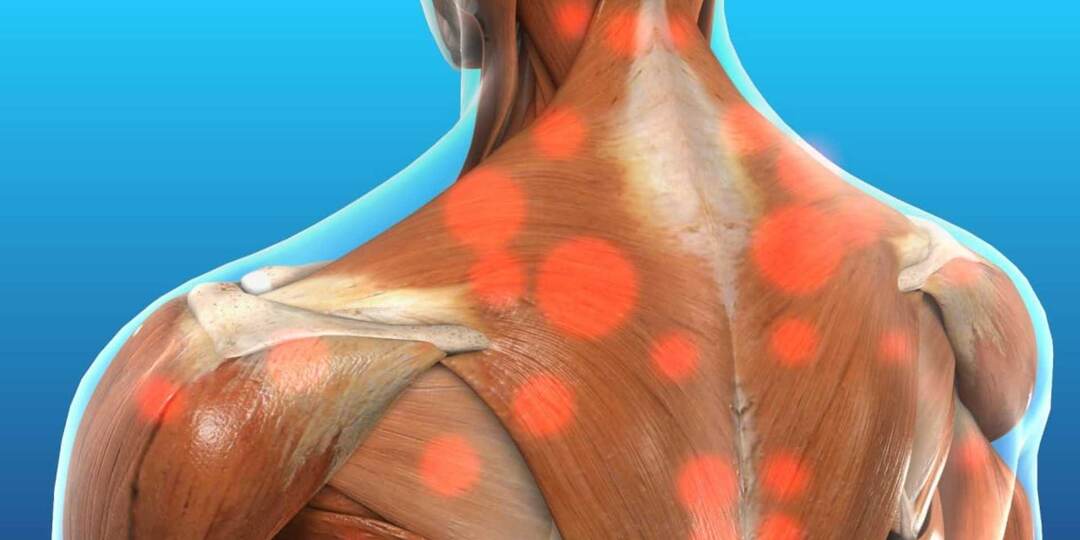 Триггерная терапия: целевое устранение мышечной боли