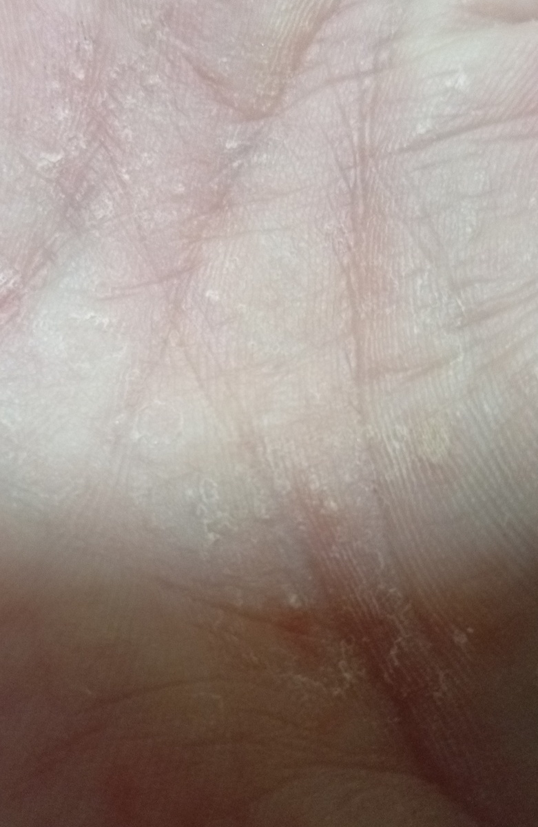 Так выглядят мои руки, кожа, как в голове, так же на лице руках и местами на теле. Это ладони. 