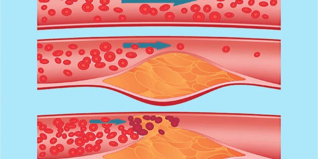 Почему сосуды "взрываются" после 60 — и как этого избежать