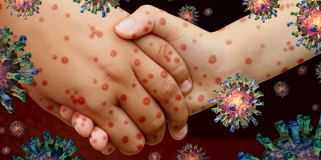 Болезнь Коксаки: что это за вирус и почему он так пугает родителей?