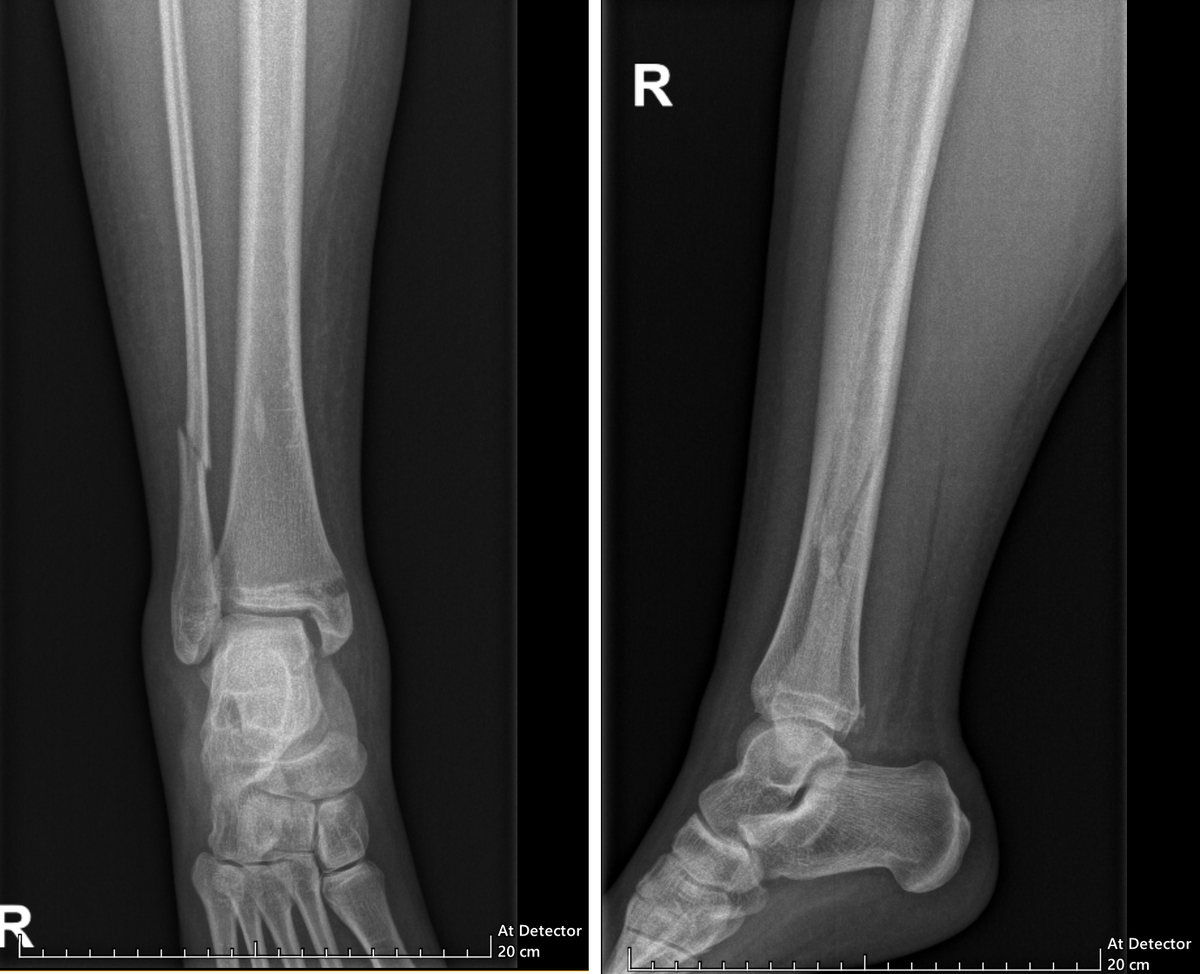 А это сам перелом при поступлении в Склиф. https://dzen.ru/woodduck