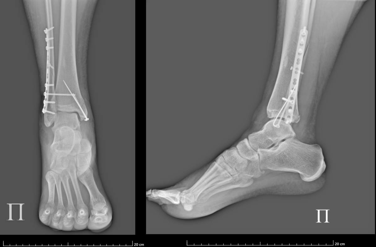 Это богатство металлоостеосинтеза бережно ношу пока в себе. https://dzen.ru/woodduck