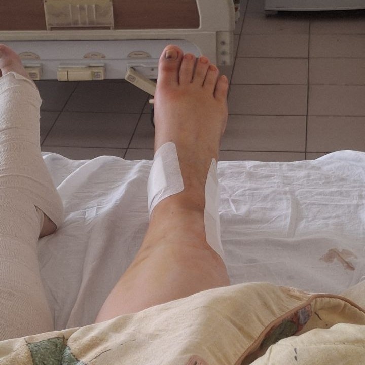 Мне сняли гипс на следующий же день после операции