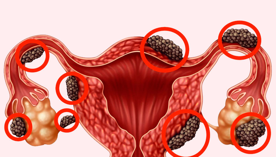Как понять, что нужно удалять эндометриоз