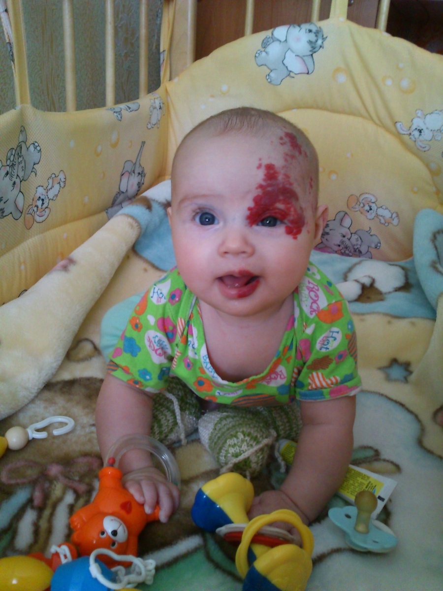 Ярко-алые гемангиомы, как у Даши, еще называют «винными пятнами» или «поцелуями ангелов». Изображение из личного архива героев публикации.