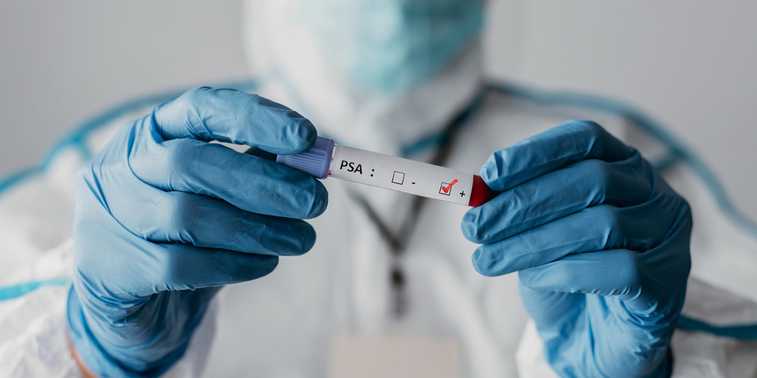 Тесты на онкомаркеры — когда время играет роль