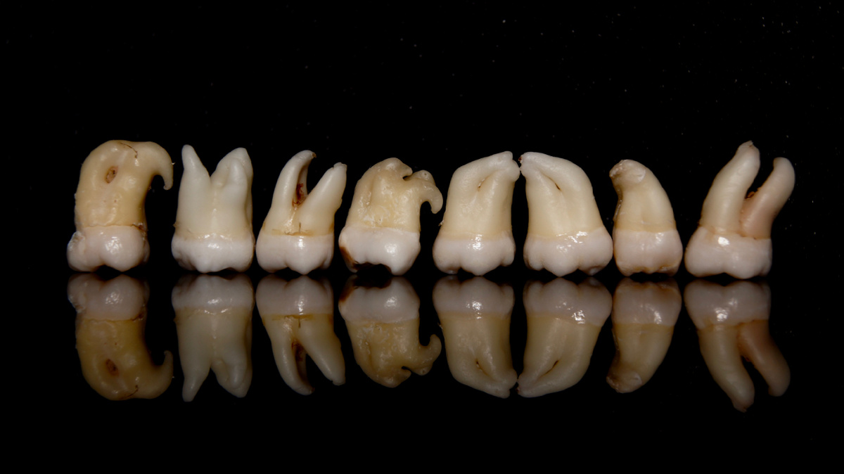 Третьи моляры или зубы «мудрости»