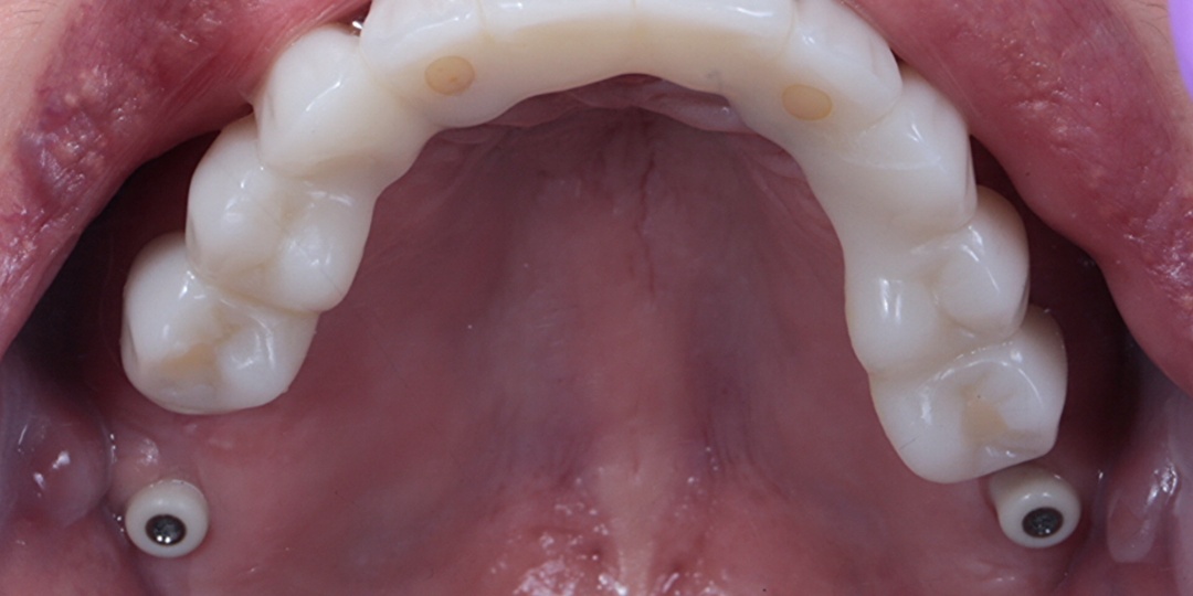 Как проводится all-on-6?