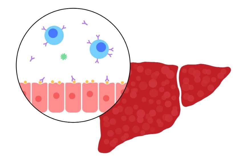 Рис. 1. Аутоиммунный гепатит
