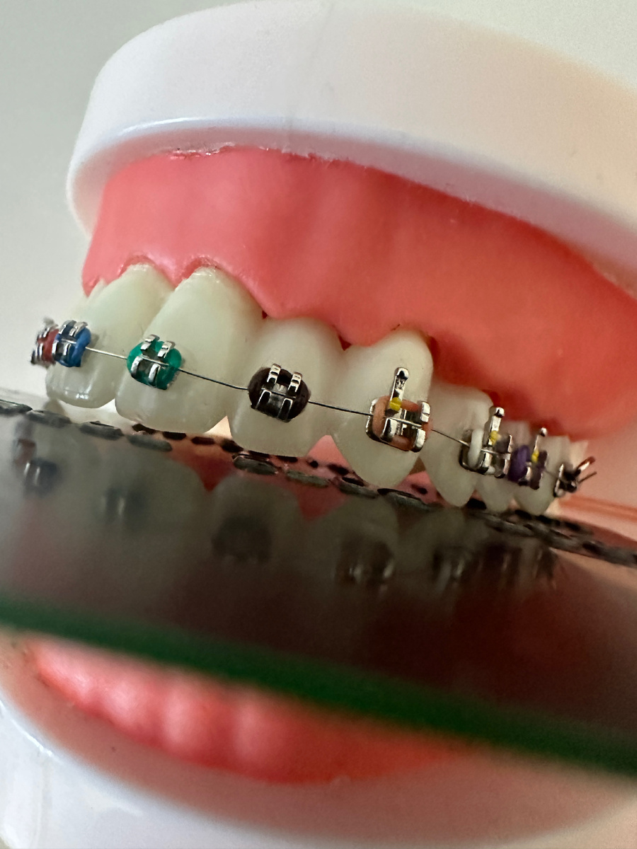 Цены на брекеты