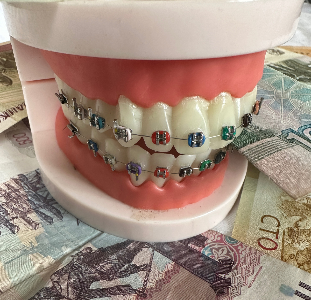 Брекеты стоимость 