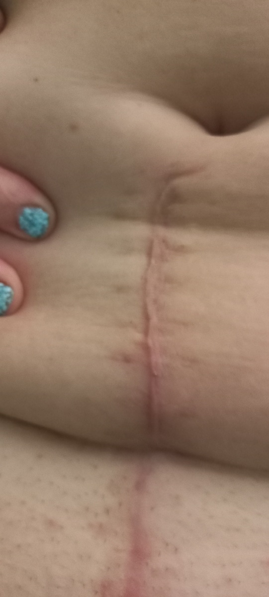 Трехмесячный шрам