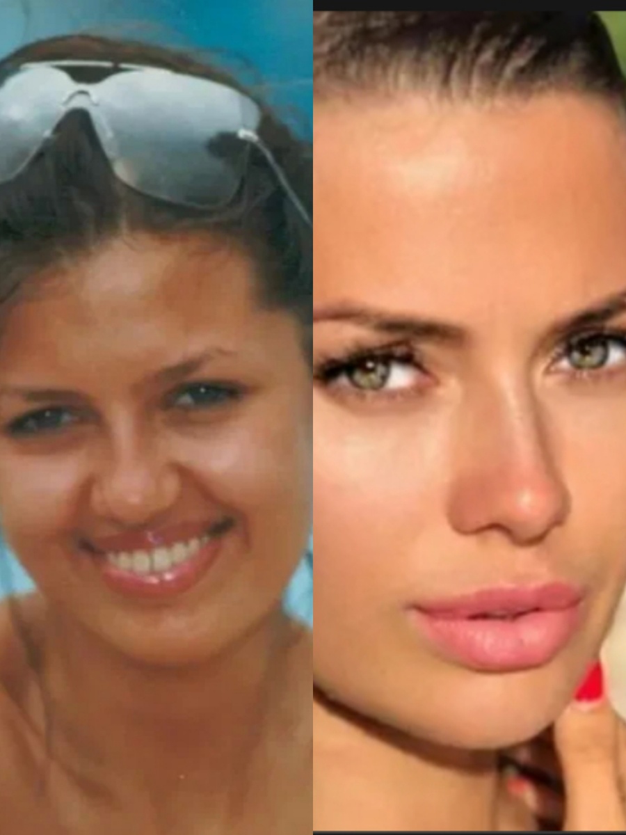 До пластики и после