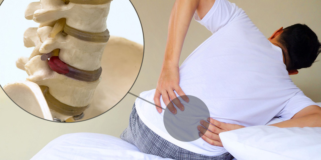 Грыжа межпозвонкового диска: что можно, а что нельзя