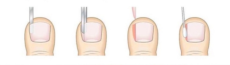 Схематичное изображение краевой резекции вросшего ногтя