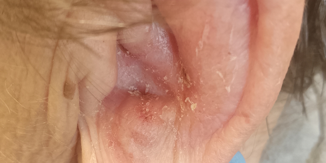 Синдром Рамсея-Ханта