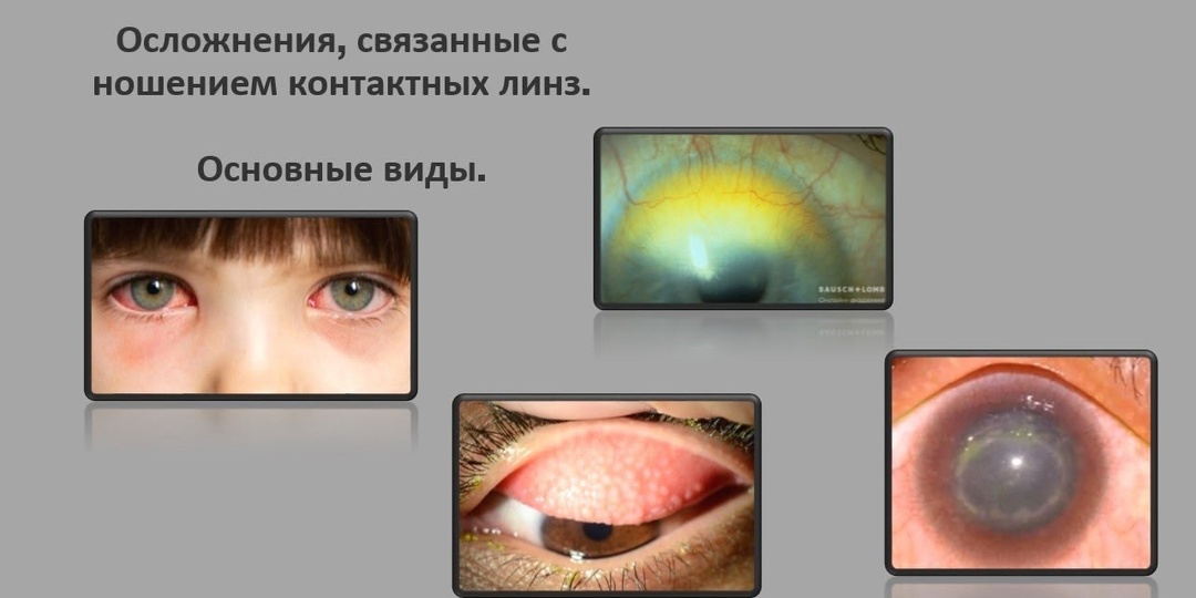 Осложнения, связанные с ношением контактных линз