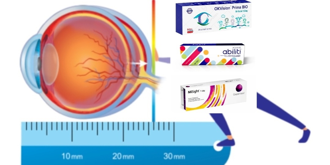 Мягкие контактные линзы для замедления прогрессирования миопии у детей.