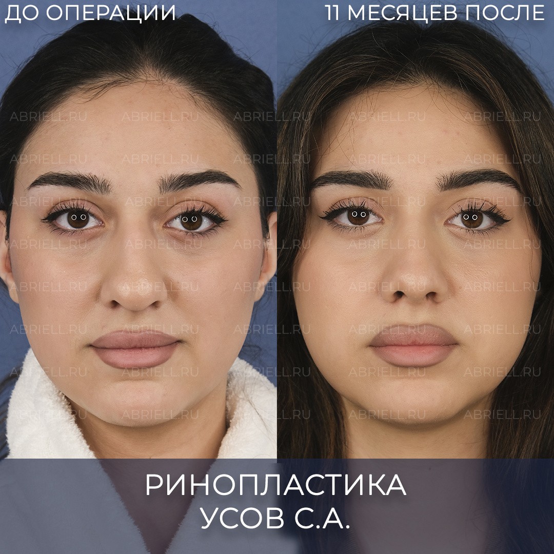 ринопластика в санкт-петербурге