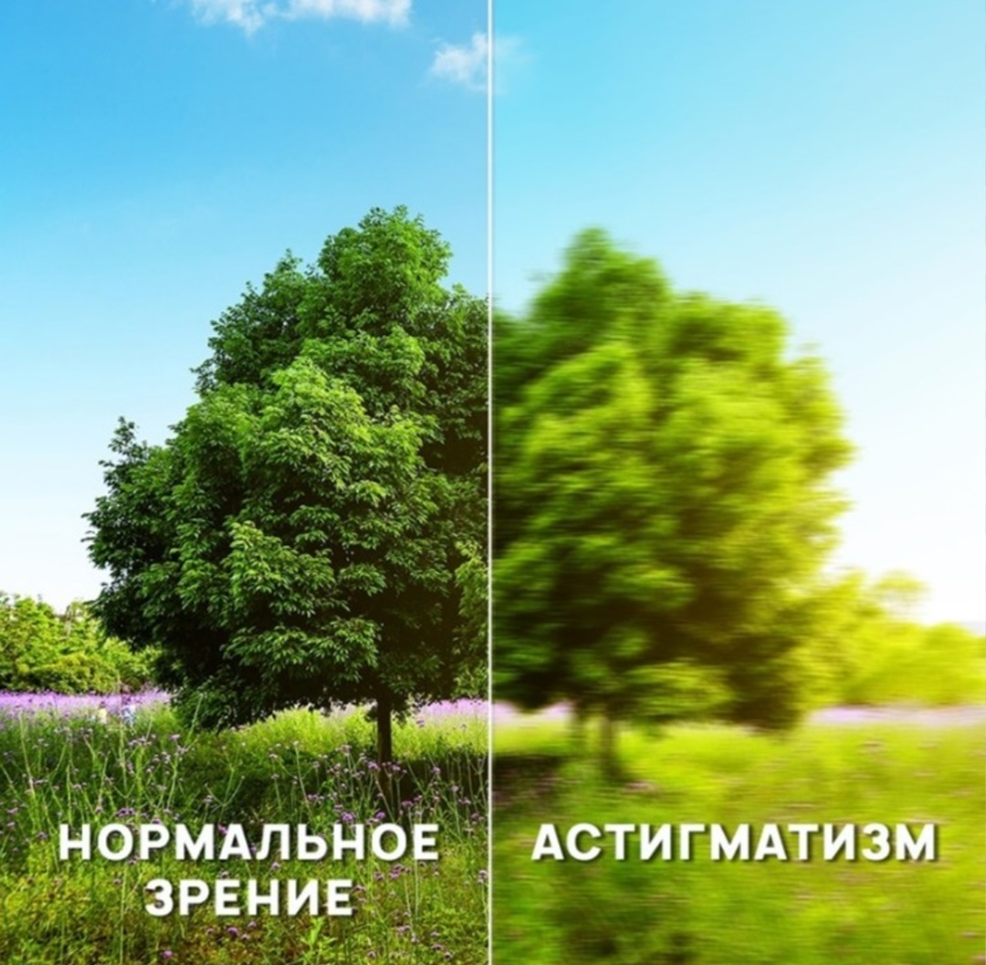 Астигматизм.