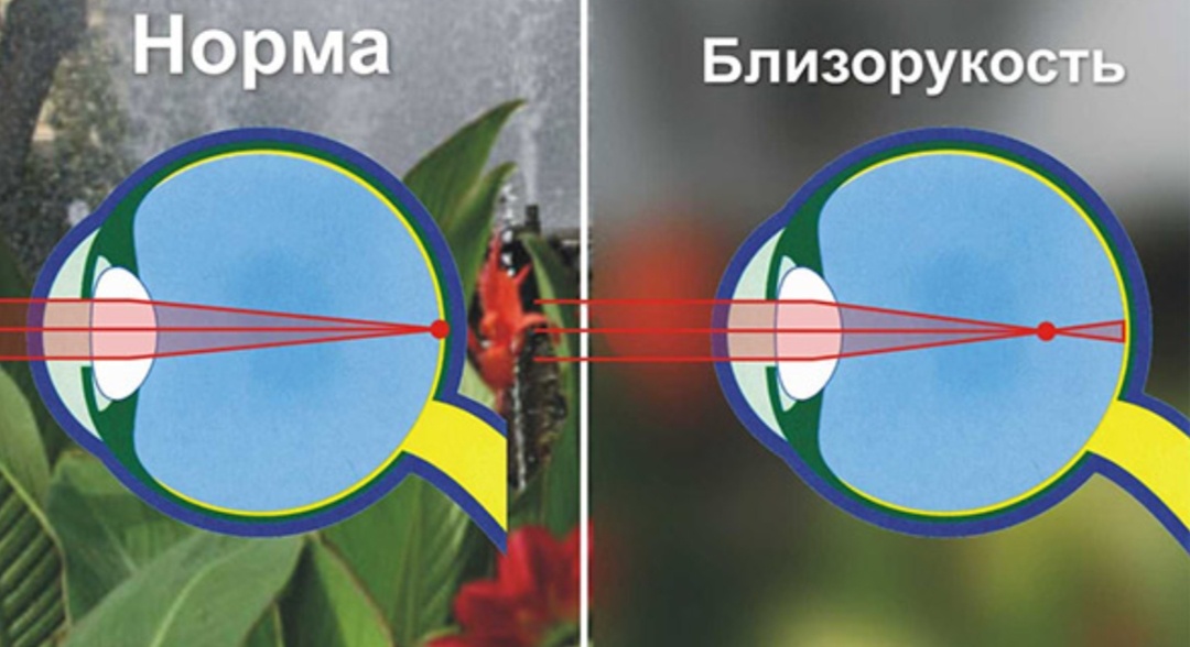 Миопия.