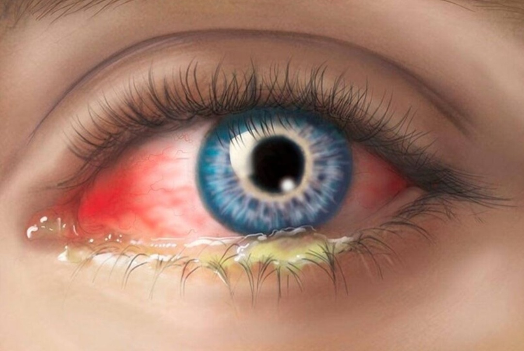 Конъюнктивит.